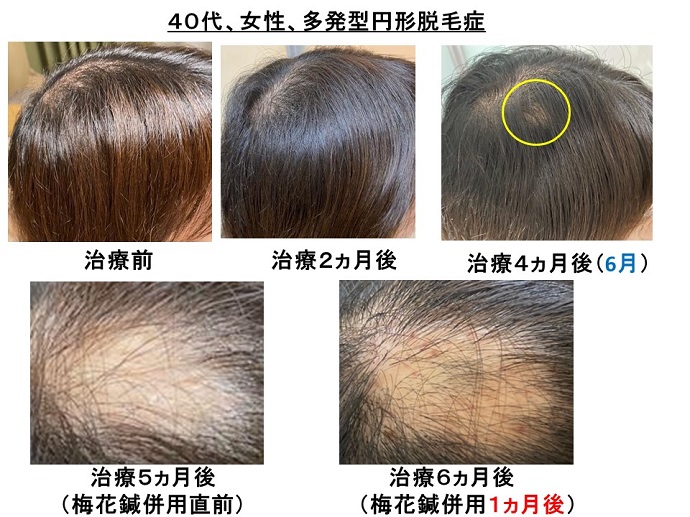 円形脱毛症　病院